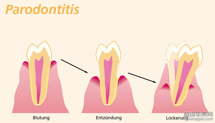 parodontitisverlauf.jpg